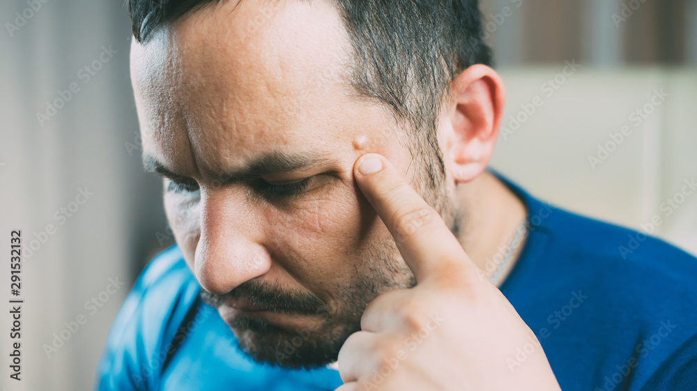 Fototapeta premium The tumor on the face of men near his temple , Lipoma Wen or zit, ugly acne, dermatology and ugliness