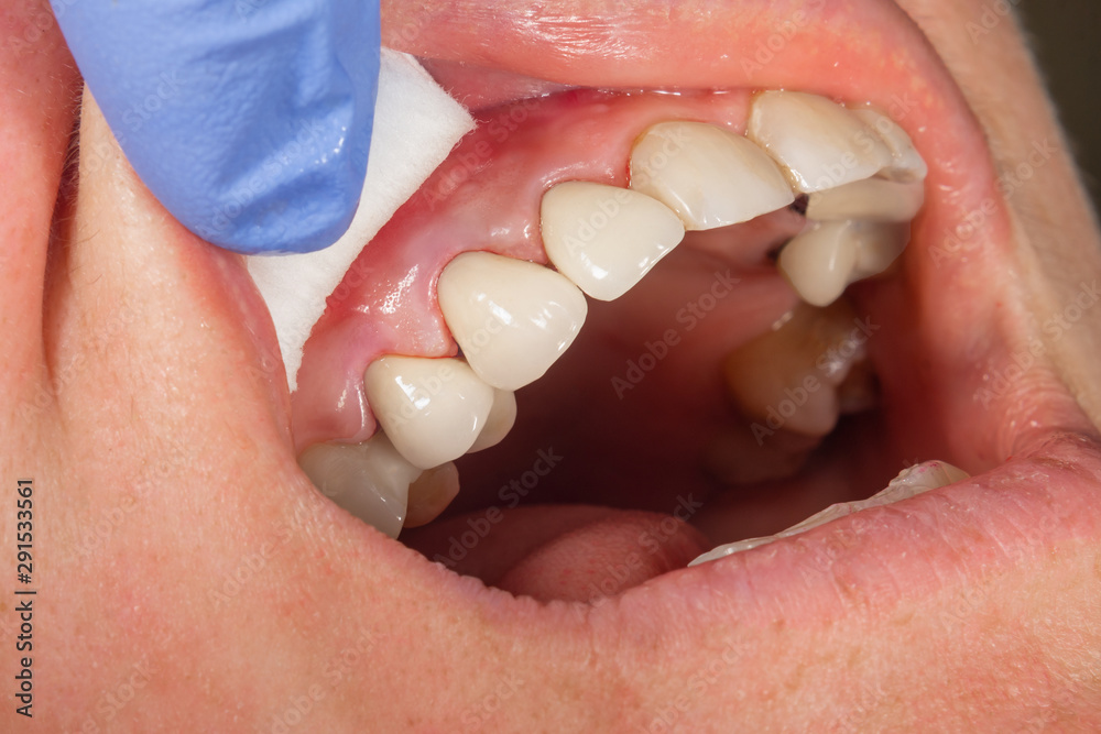 ceramic crowns of human teeth closeup macro isolate on black background