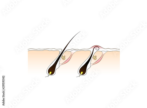 Hair growth. Ingrown hair skin inflammation scheme. Hair follicle treatment vector illustration