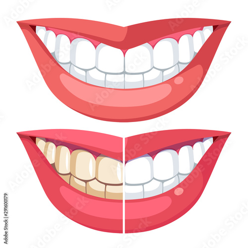 Comparing teeth with plaque, healthy hygiene white