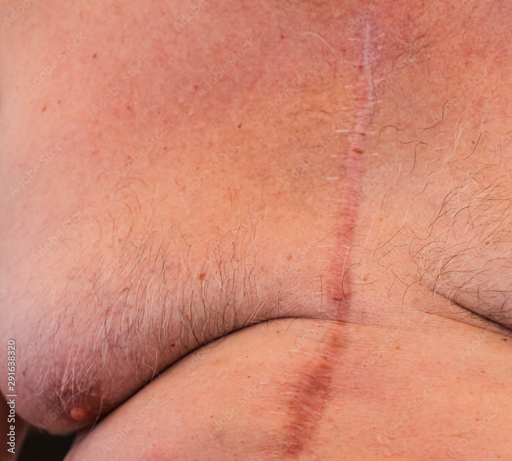 Fototapeta premium A scar from a heart operation