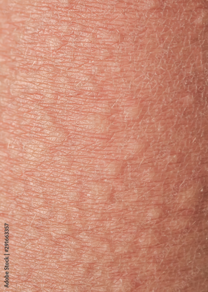 Fototapeta premium background of texture of unhealthy irritated human skin covered with fine lines ,cracks and blisters burns