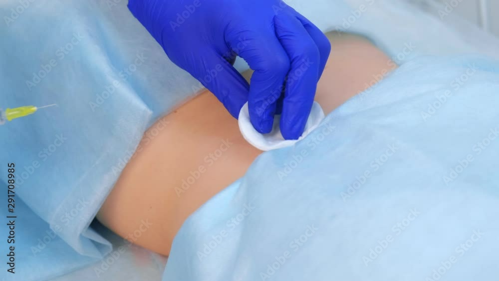 Surgeon in gloves gives injection of local anesthesia to patient before laser removing mole on back, closeup view. One day surgery concept. Removing nevus or birthmark. Cosmetic treatment. Surgeon in gloves gives injection of local anesthesia to patient before laser removing mole on back, closeup view. One day surgery concept. Removing nevus or birthmark. Cosmetic treatment.
