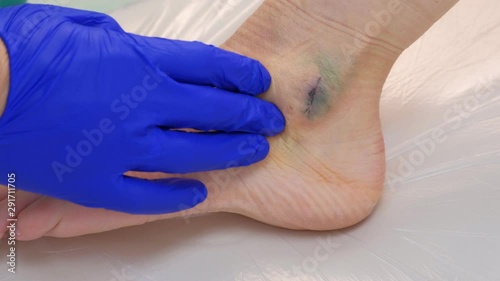 Surgeon palpates leg around suture after surgery to remove ankle hygroma, hand closeup. Recovery, rehabilitation, therapy and treatment after surgery. Wound healing with stitches.