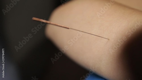 Acupuncture.Dry needling.A close-up of a needle sticking into a patient's forearm.Trigger point therapy.Traditional Chinese medicine photo