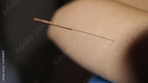 Acupuncture.Dry needling.A close-up of a needle sticking into a patient's forearm.Trigger point therapy.Traditional Chinese medicine