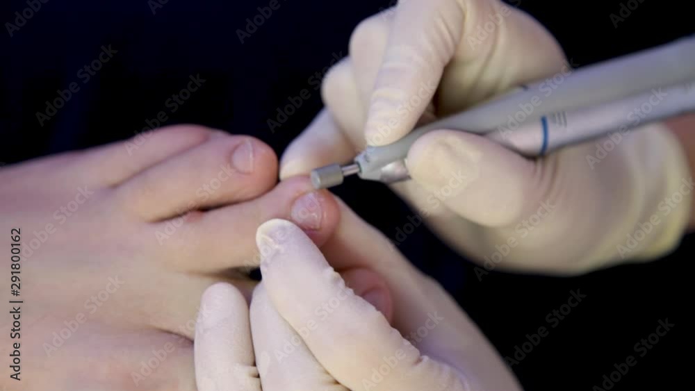 Hardware pedicure.Podology.Podologist works with the patient's middle toe.Close-up Hardware pedicure.Podology.Podologist works with the patient's middle toe.Close-up