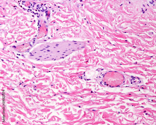 Dermis of thin skin. arrector pili muscle photo
