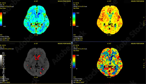 CT Brain Perfusion or CT scan image of the brain 3d rendering image analysing cerebral blood flow on the monitor.