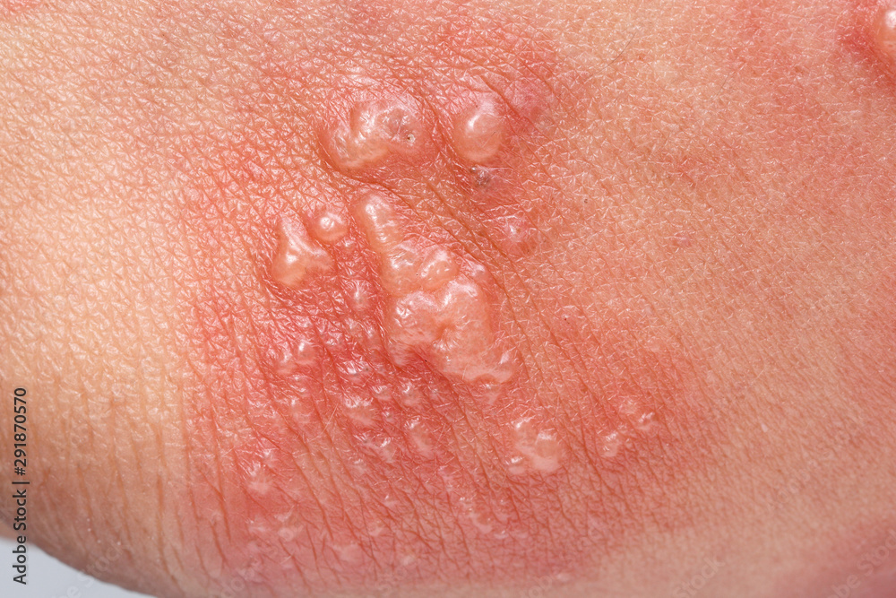 Shingles, Zoster or Herpes Zoster symptoms on arm Shingles, Zoster or Herpes Zoster symptoms on arm