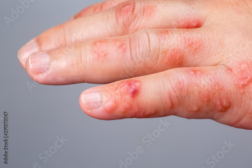 Tableau sur toile Shingles, Zoster or Herpes Zoster symptoms on arm