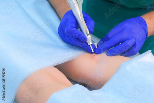 Doctor surgeon removes birthmark using laser on patient leg  hands in gloves closeup. One day surgery concept. Removing mole making surgical procedure by burning with laser beam. Cosmetic treatment.