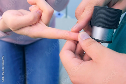 Surgeon examines wart on finger of woman patient using dermatoscope magnifier before laser removing. Inspecting verruca on hand  cure and treatment. One day surgery concept.