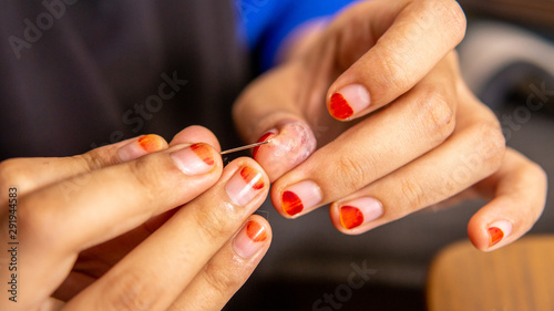 Removing pus in the wound infection from the thumb. Infected, fingers.