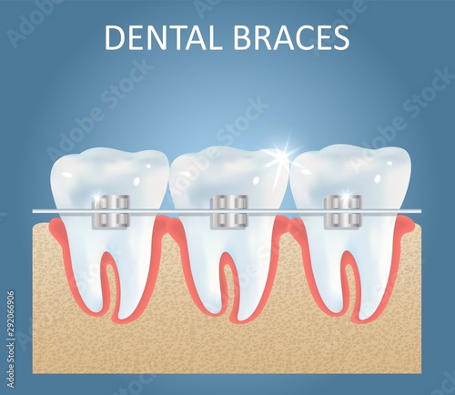 Dental braces vector medical poster design template