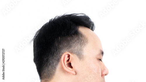 Close up of serious Asian bald man alopecia isolated on white background. Human hair loss solution concept.