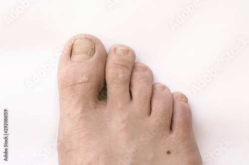 Il termine micosi indica la condizione in cui dei funghi patogeni superano la resistenza delle barriere del corpo umano o degli animali provocando infezioni.