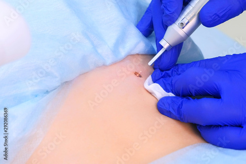Doctor surgeon operation removes mole using laser on patient back  closeup view. One day surgery concept. Removing birthmark making surgical procedure by burning with laser beam. Cosmetic treatment.