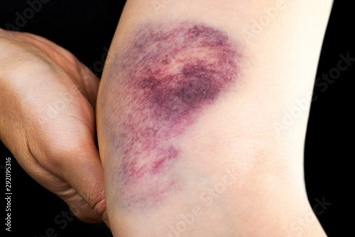 Close up of a hematoma on woman arm near elbow. photo