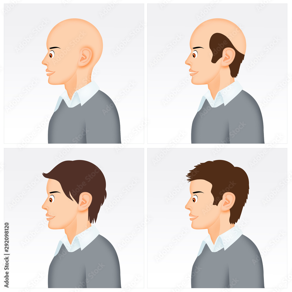 illustration of baldness illustration of baldness