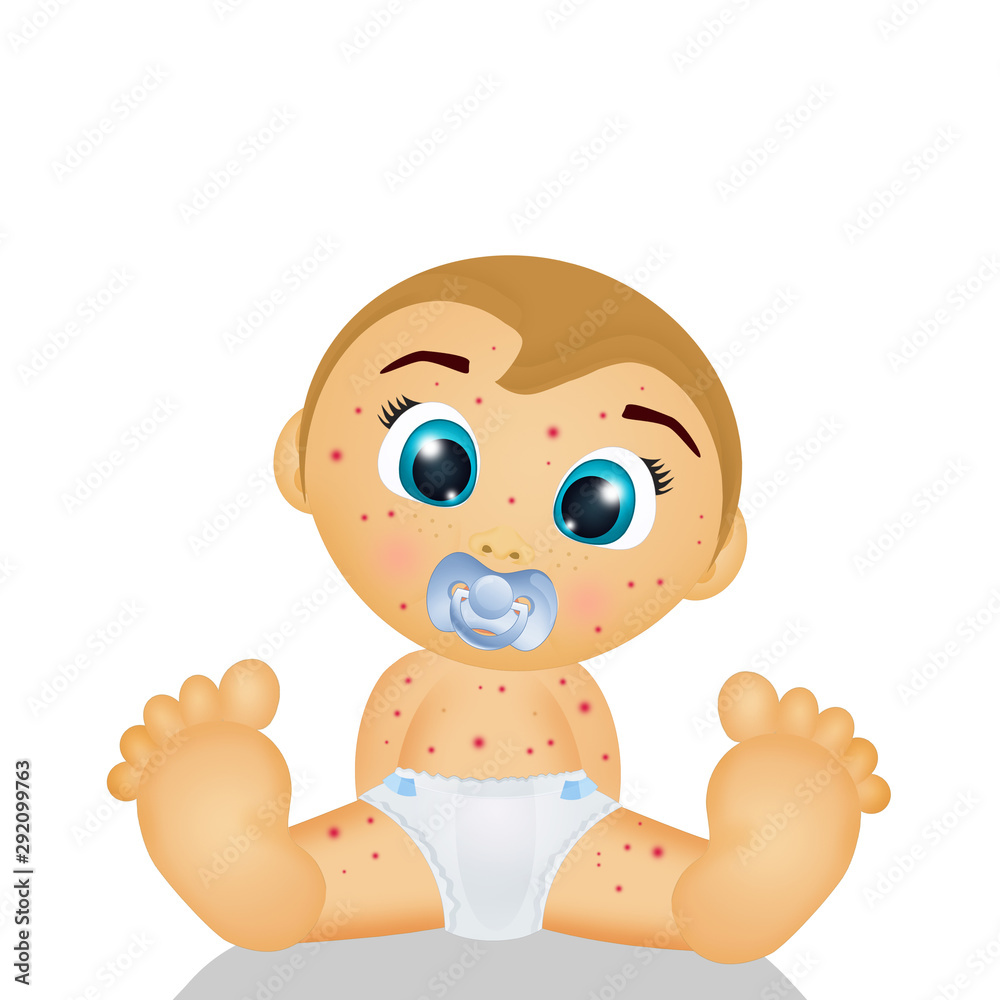 baby with chicken pox baby with chicken pox