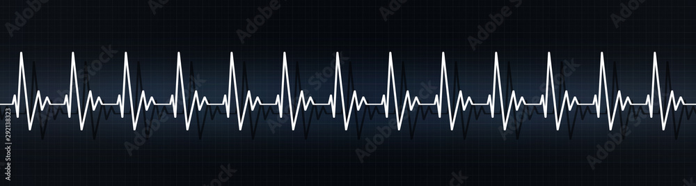 rapid heart pulse beats on ecg