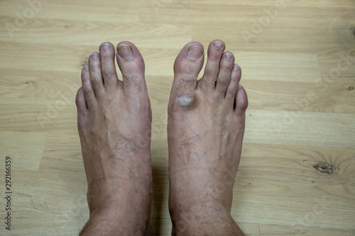 Hard dead skin above the toe of right foot due to sitting on ground for extended hours