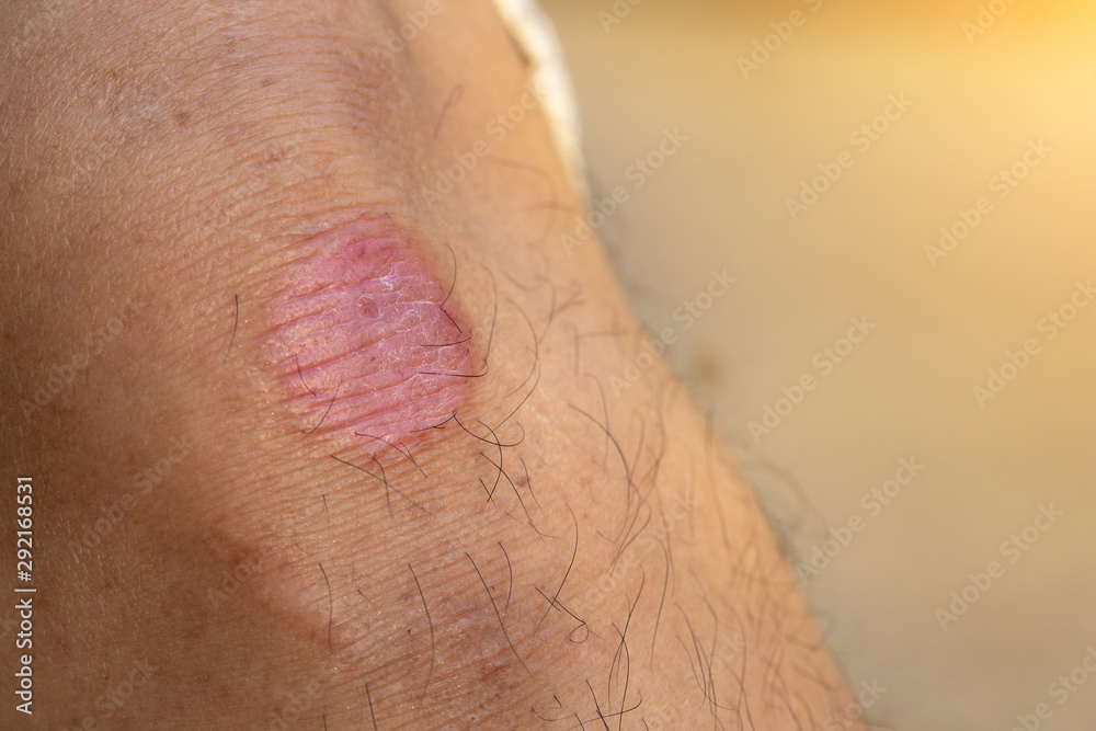 Ring Worm infection, Dermatophytosis on skin. Ringworm infection or
