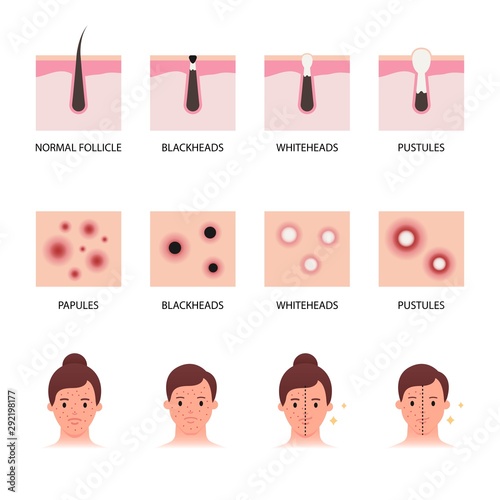 Acne formation and types vector illustration