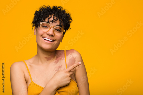 Young african american woman with skin birth mark smiling and pointing aside, showing something at blank space.