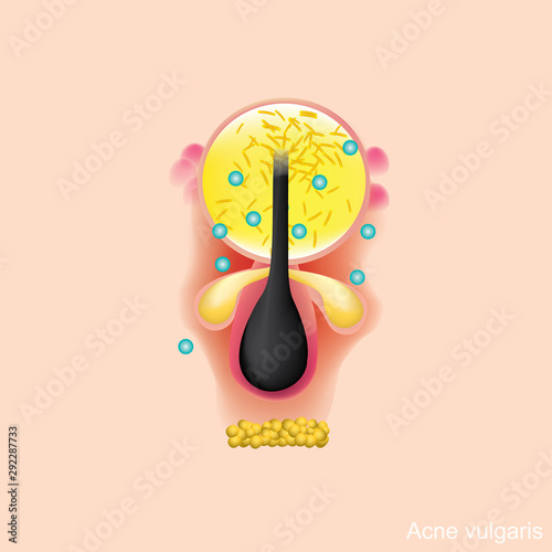 Acne vulgarise is a long-term skin disease that occurs when hair follicles become clogged with dead skin cells and oil from skin.