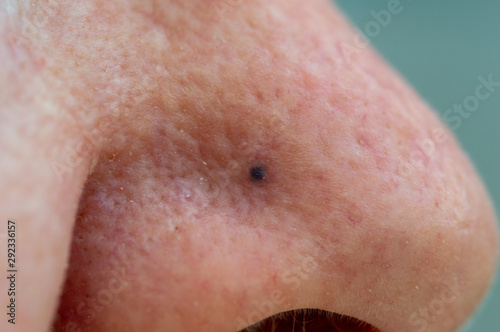 Blue nevus on an elderly lady's nose. Close up of the small dark dot. Some malignant melanomas can look like blue nevi. photo