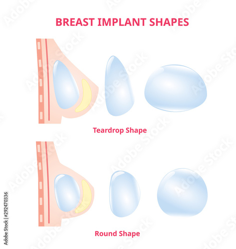 Breast implant Silicone compare round and tear drop, Breast surgery,