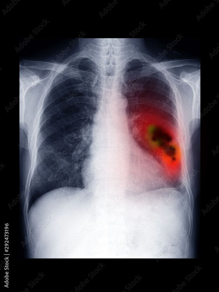 film xray chest radiograph (CXR) show lung mass. Lung cancer or carcinoma is malignant tumor