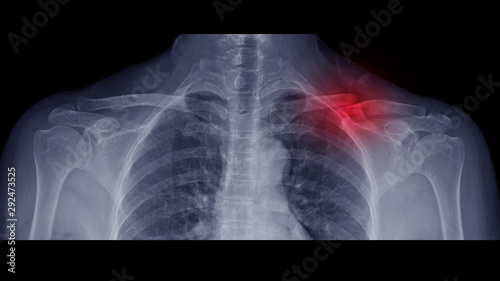 Obraz na płótnie Film X-ray shoulder radiograph show Left collar bone broken (clavicle fracture) from traffic accident