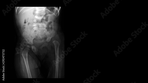 Film X ray hip radiograph show congenital developmental dysplasia of left hip(DDH) disease with hip joint subluxation. The patient has hip pain, limping and walking problem. Medical technology concept photo