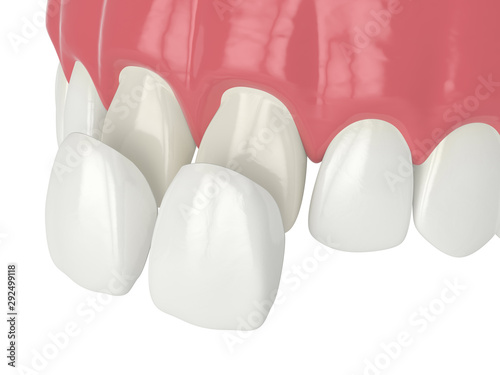 3d render of upper jaw with veneers