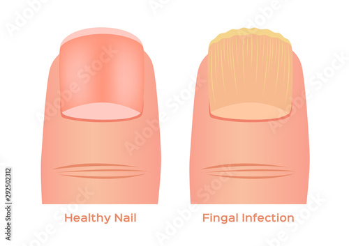 toe nail fungal infection vector