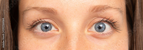 A closeup view of a young and pretty Caucasian woman with blue eyes, suffering from strabismus. A condition that causes the eyes not to align with each other.