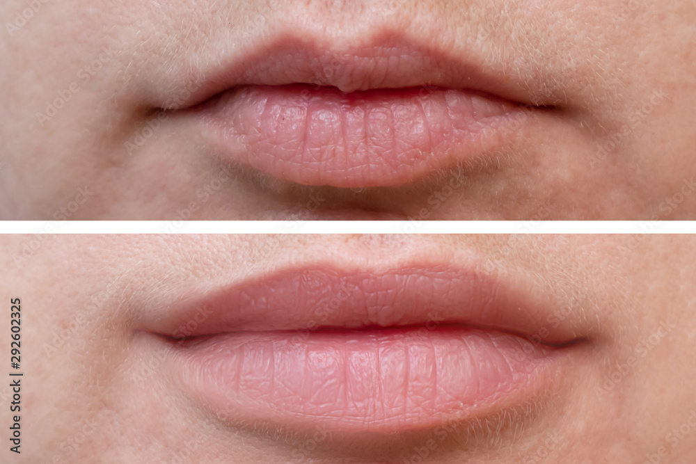 Obraz premium Female lips before and after augmentation, the result of using hyaluronic filler