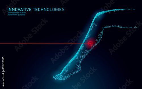 3D woman leg endovenous laser operation concept. Medical surgery veins varicose treatment female foot. Cosmetic hair laser depilation healthy massage salon care vector illustration