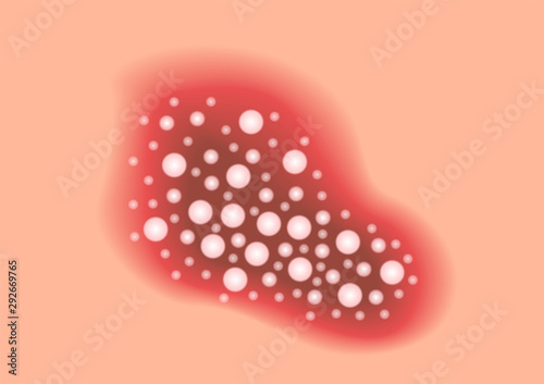 skin disease vector / psoriasis on hip