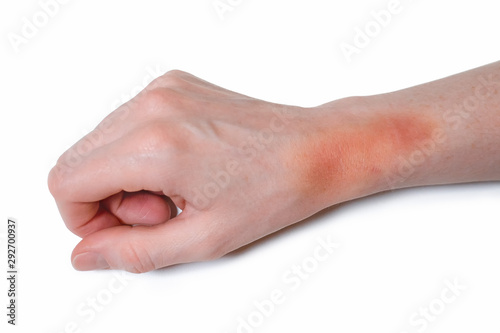 Female hand with big bruise on white background. Ointment treatment.