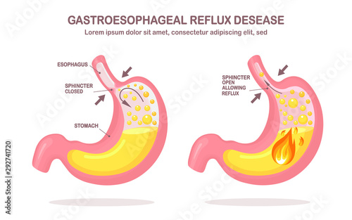 Human stomach. Gastroesophageal reflux disease. GERD, heartburn, gastric infographic. Acid moving up into the esophagus. Vector flat design