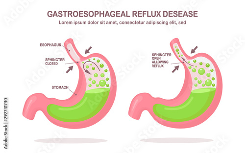 Human stomach. Gastroesophageal reflux disease. GERD, heartburn, gastric infographic. Acid moving up into the esophagus. Vector flat design