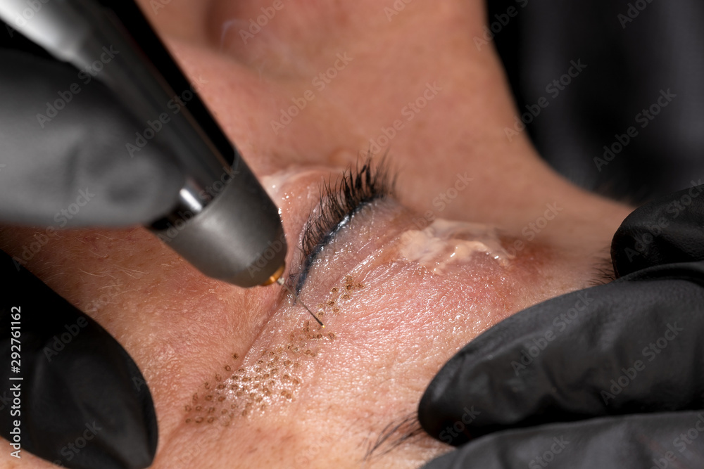 Women eyelid lifting, fibroblast procedure. - obrazy, fototapety, plakaty 
