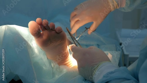 Surgeon sews wound on leg after surgery using self-absorbable threads, hands closeup. Doctor sutures ankle during surgery with neat stitches after removing hygroma. One day surgery concept.