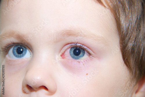 conjunctivitis in the eye of a child. Ophthalmic diseases. Red eye . Vessels burst in the eye.