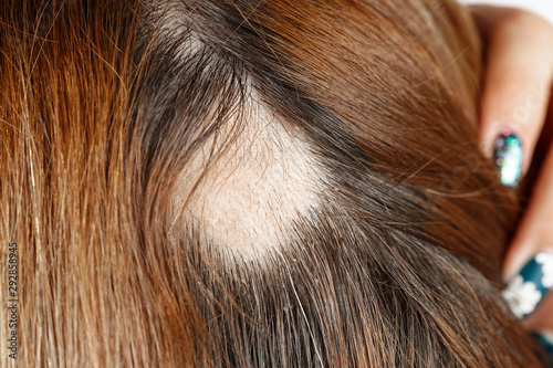 30 year old Caucasian woman with spot alopecia, bald spot on her head