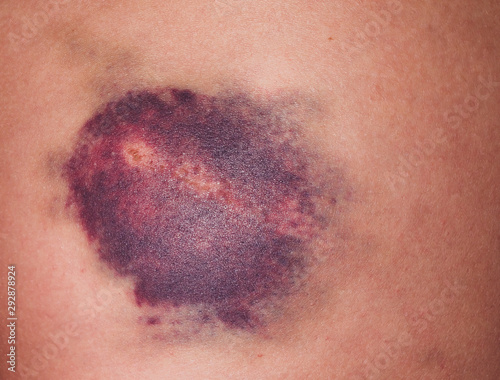 Bild auf Leinwand Injury of the knee joint. Big bruise on knee.